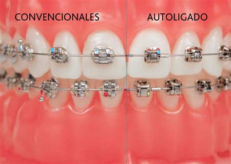 brackets autoligado metalico|diferencia entre bracketes y autoligados.